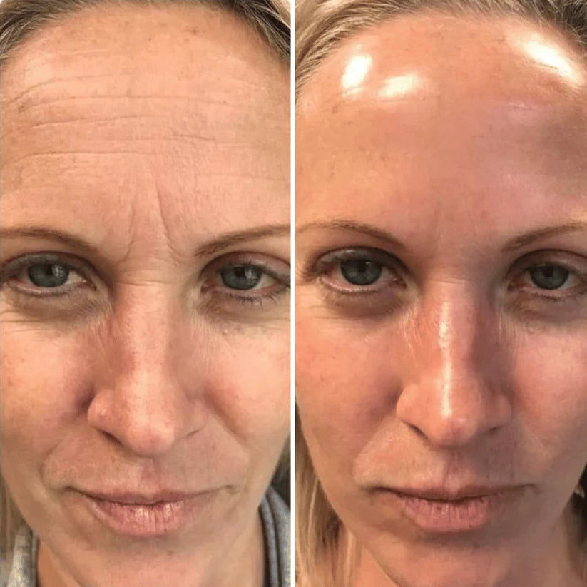 Retinal Shot: Rejuvenece tu rostro, despídete de arrugas